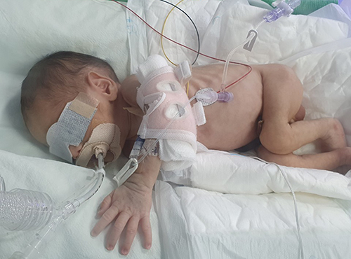 32주만에 1.4kg으로 태어난 삼야스는 인공호흡기에 의지한 채 위태로운 숨을 내뱉고 있다.